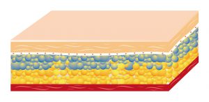 Fat Freezing Treatment, Cryolipolysis technology, How it works Step 2