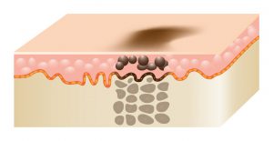 Pigmentation Removal for Melasma, Freckles, Sunspots, Moles and more. How it works Step 1