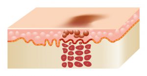 Pigmentation Removal for Melasma, Freckles, Sunspots, Moles and more. How it works Step 2