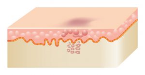 Pigmentation Removal for Melasma, Freckles, Sunspots, Moles and more. How it works Step 3