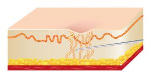 Acne Scar Removal using Subcision. How it works Step 1