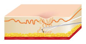 Acne Scar Removal using Subcision. How it works Step 2