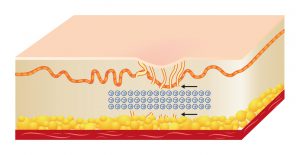 Acne Scar Removal using Subcision. How it works Step 3