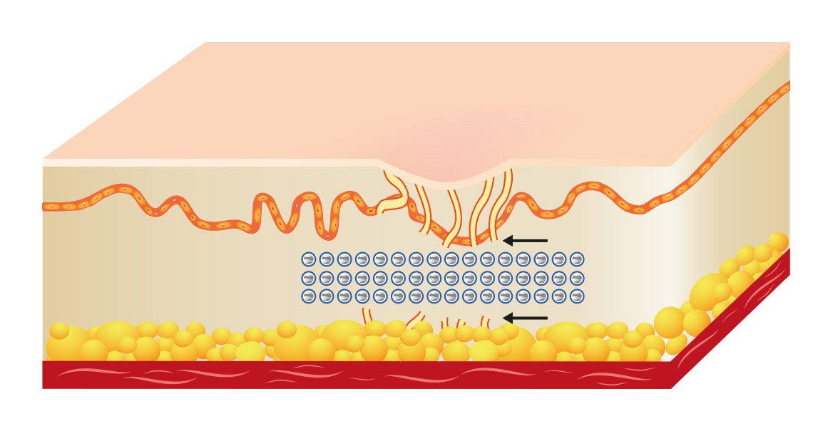 Acne Scar Removal – Scinn Medical Centre