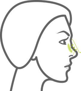 Nose Augmentation with Fillers Step 2